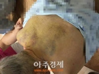전남 보성 한 요양병원서 90대 치매환자 시퍼런 멍 자국에 골절…경찰 수사 중