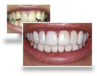 [TMJ치과]치아교정으로 당당하고 자신감 있는 웃음을 되찾기