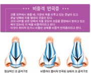 [코성형] 비중격 만곡증은 휜 코와 함께 교정해야