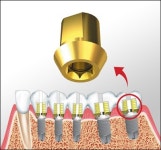 [VOD] 당신의 임플란트, A/S 받아 보셨습니까?