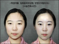올 여름성형 트랜드는 퀵, 회복도 시술도 퀵-퀵쌍꺼풀