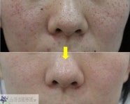 기미·주근깨 생기기 쉬운 여름, 깨끗한 피부 지키려면? 대구 스타S피부과 레블라이트 레이저토닝 주목