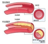 혈관 속 기름 고지혈증 방치하면 생명위협