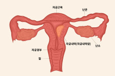 2030 자궁내막암 적신호…'이 증상' 있다면[건강]