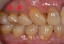 [건강한 치과] 시린 치아 치경부 마모증의 원인과 치료