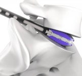 시지바이오, 차세대 높이확장형 케이지 엑센더 출시