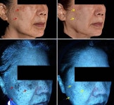 레이저옵텍, 헬리오스785 스킨 리쥬비네이션 연구 SCI 저널 등재