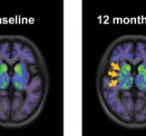 에스바이오메딕스, 파킨슨병 세포치료제 임상 결과 Cell지 발표
