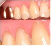 이석재 건강칼럼 치경부 마모 원인과 치료 예방법