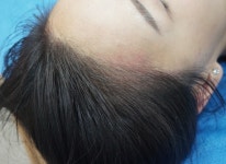 동안 외모 갖게 해주는 반영구헤어라인, 얼굴형에 맞게 시술해야