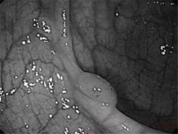 대장암 예방, 정기적인 대장내시경 검사 필수