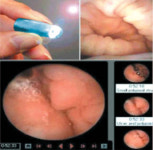 캡슐형 내시경 검사, 임산부 등 금지