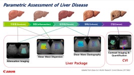 캐논메디칼, 간질환 초음파 진단기술 입증