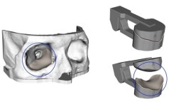 안와골절 임플란트 가이드, 혁신의료기술 선정