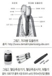 의료기기시장 성장 이끌 품목? 임플란트·혈당측정기