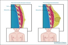 가성 여성형 유방증 수술 없는 냉동치료 효과 입증