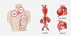 상행대동맥 늘어나는 대동맥류 파열확률 3% 미만