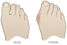 무지외반증이 인플루언서 직업병으로 지목된 이유는?