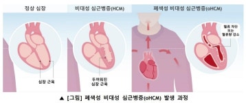 '먹는 수술' 된 심장치료…폐색성 비대성 심근병증 바꾼 '캄지오스'