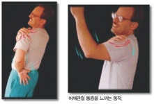 [김용욱 건강 칼럼]오십견, 초기에 치료하지 않으면…