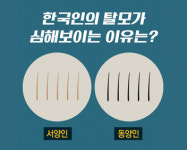 [홍성재 탈모 칼럼] 한국인의 탈모가 심해 보이는 이유