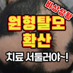 [홍성재 탈모 칼럼] 원형탈모 → 전두-전신 탈모로 악화 안되게 치료 서둘러야