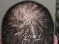 초이스피부과의원, 가을철 탈모주의보