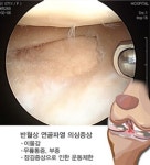 반월상 연골손상, 관절경으로 치료할 수 있다