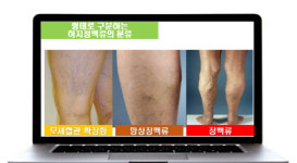 하지정맥류 수술, 현명한 환자는 이걸 확인한다