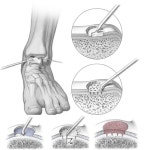 발목연골 손상, 줄기세포 이용해 뿌리부터 재생 치료 가능