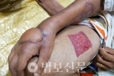 피부는 죽었지만 농장 운영 꿈까지 놓을 수 없어
