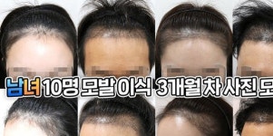 '아는 형님' 이채연, 모발 이식 고백