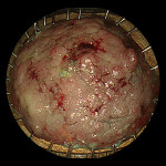 조기 대장암, 내시경시술로 치료 가능해요