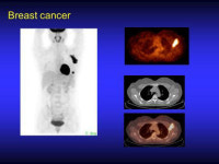 초기 암 검진엔 펫시티(PET CT) 전신촬영