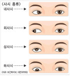 [건강]어린이 사시 조기 교정하세요