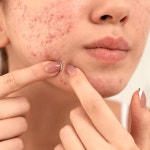 여드름흉터 레이저 치료, 유형별로 최적화된 어븀에어셀 고려해야