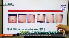 [건강 365] 나잇살 슬기롭게 빼자 ‘지방흡입’ 11/8 2'59''