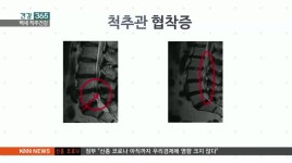 [건강 365]튼튼한 척추 백세까지, 협착증을 조심하라!