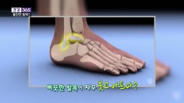 [건강365]불안한 발목, 관절염 부른다?