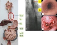 식도에도 암이 생기나요? [심찬섭 교수의 소화기질환 이야기]