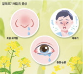 코감기 닮은 알레르기 비염…최고 예방법은 꽃가루·황사 피하기
