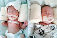 “‘극단 저체중’ 알콩이·달콩이를 도와 주세요”