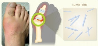 20·30男 절반이 고요산혈증…통풍, 중년 질환 아니다