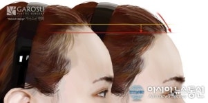 넓은 이마 개선하는 이마성형, 헤어라인 교정 동시에