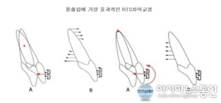 ‘에투알드서울치과’ RTS 치아교정장치, 교정효과에 미적 효과까지 탁월