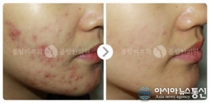 여드름흉터 없는 피부로 외모 자신감을 올리자!