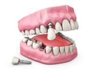 틀니와 임플란트의 가격차이   다른 점이 무엇이길래?   부작용까지