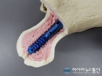 오송재단-(주)티디엠, ‘골수내고정막대’ 특허등록