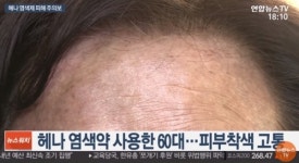 어쩌다 이런일이? 헤나 염색 부작용, 검게 변한 피부… 원상태로 못 돌아가