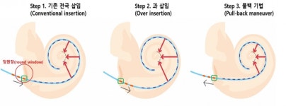 영상-유전자 기반 정밀의학적 인공와우 수술 정립…분당서울대병원 최병윤 교수 연구팀